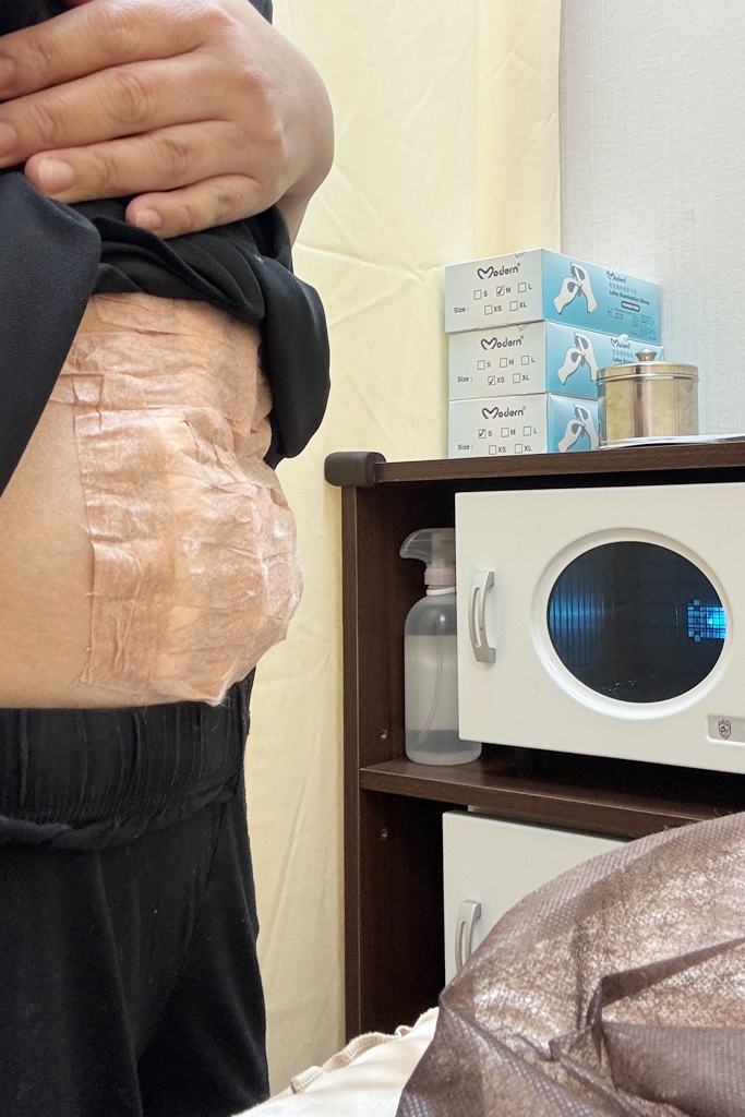 【澤予堂元熙中醫診所】3.1KG的減重心得，中醫埋線搭配飲食調整，2個月衣服小了一個尺寸 @飛天璇的口袋